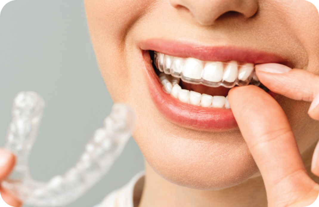 Photo of a woman putting on her Invisalign braces